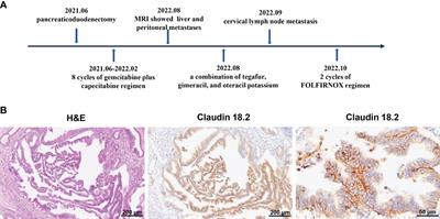 Complete remission of advanced pancreatic cancer induced by claudin18.2-targeted CAR-T cell therapy: a case report